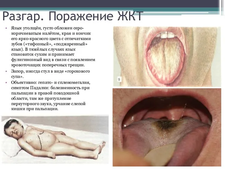 Разгар. Поражение ЖКТ Язык утолщён, густо обложен серо-коричневатым налётом, края и кончик