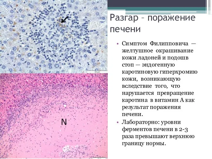 Разгар – поражение печени Симптом Филипповича — желтушное окрашивание кожи ладоней и