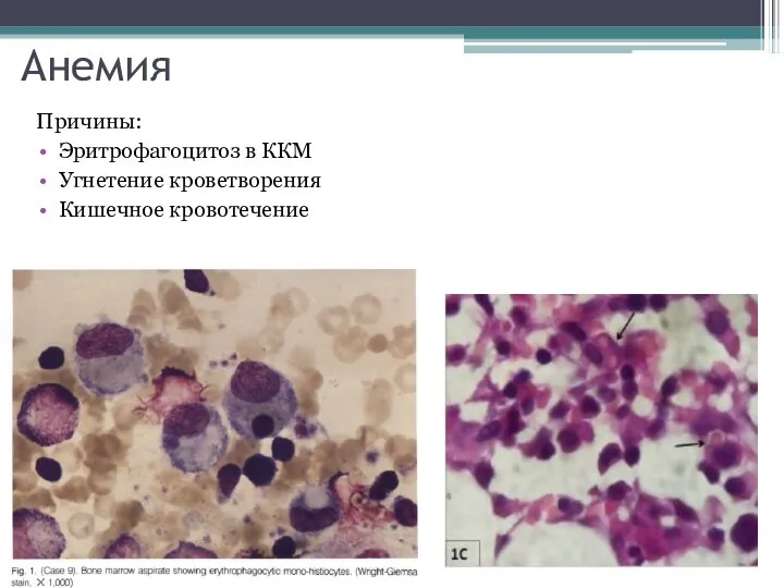Анемия Причины: Эритрофагоцитоз в ККМ Угнетение кроветворения Кишечное кровотечение