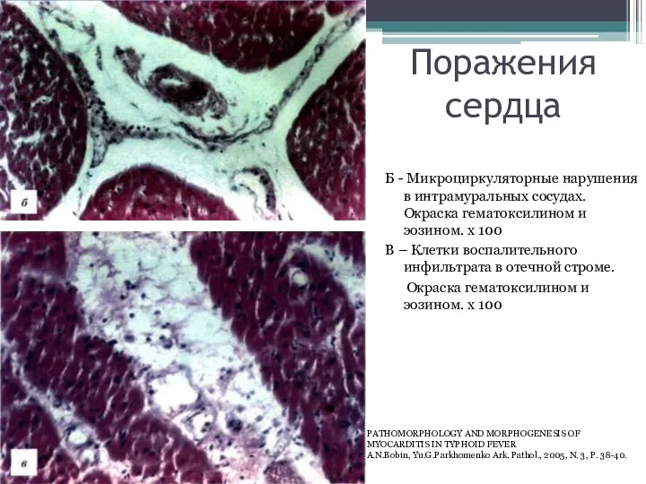 Поражения сердца Б - Микроциркуляторные нарушения в интрамуральных сосудах. Окраска гематоксилином и