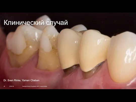 Клинический случай 27/04/18 Dentsply Sirona Prosthetics 2016 / Clinical Affairs Dr. Sven Rinke, Yamen Chaban