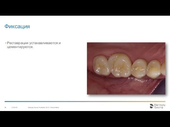 Фиксация 27/04/18 Dentsply Sirona Prosthetics 2016 / Clinical Affairs Реставрации устанавливаются и цементируются.