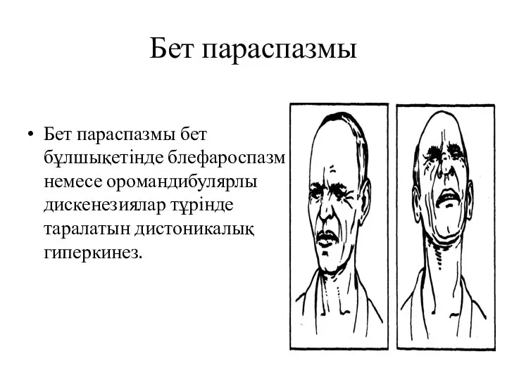 Бет параспазмы Бет параспазмы бет бұлшықетінде блефароспазм немесе оромандибулярлы дискенезиялар тұрінде таралатын дистоникалық гиперкинез.