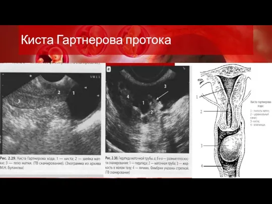 Киста Гартнерова протока