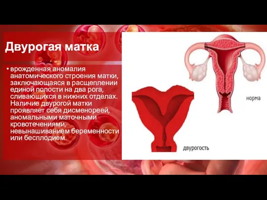 Двурогая матка врожденная аномалия анатомического строения матки, заключающаяся в расщеплении единой полости