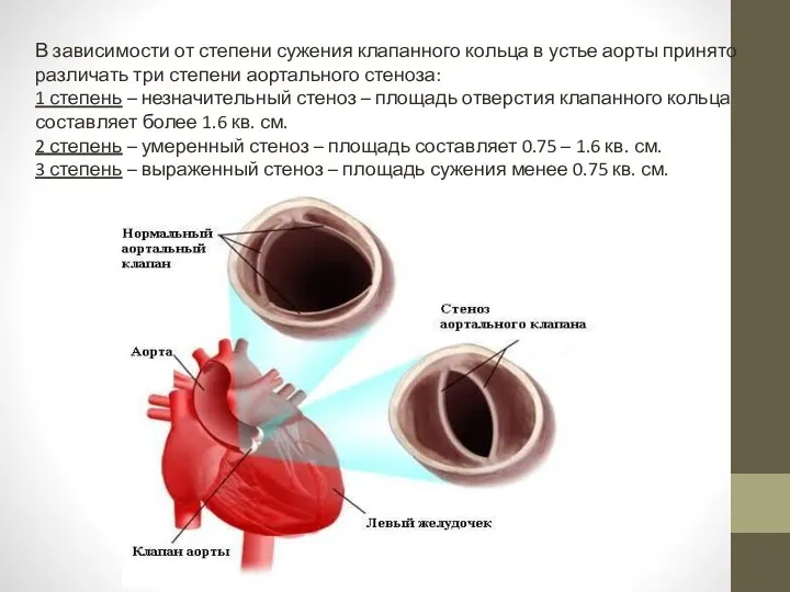 В зависимости от степени сужения клапанного кольца в устье аорты принято различать