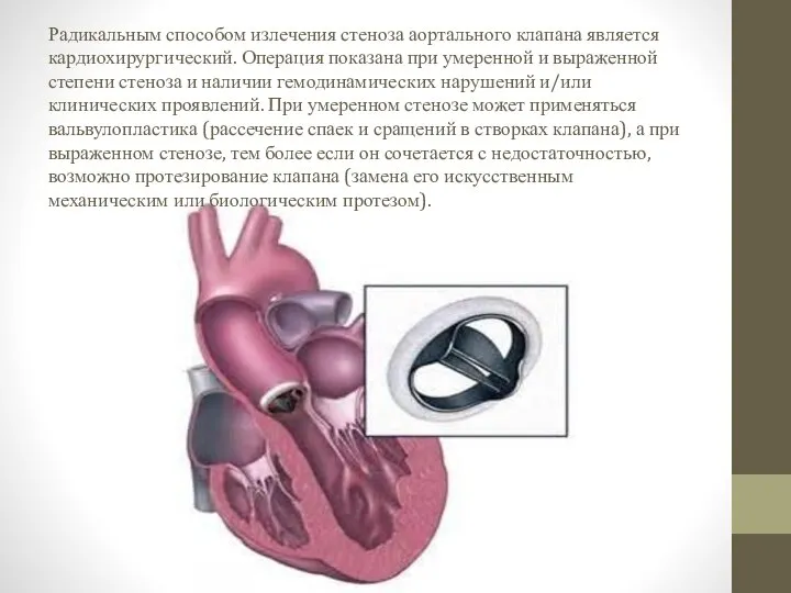 Радикальным способом излечения стеноза аортального клапана является кардиохирургический. Операция показана при умеренной
