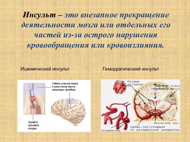 Инсульт – это внезапное прекращение деятельности мозга или отдельных его частей из-за