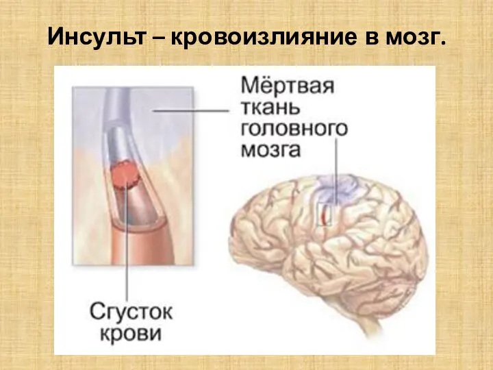 Инсульт – кровоизлияние в мозг.