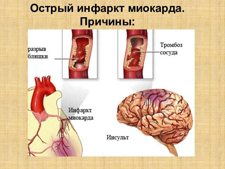 Острый инфаркт миокарда. Причины: