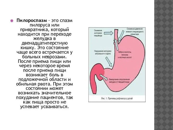 Пилороспазм – это спазм пилоруса или привратника, который находится при переходе желудка