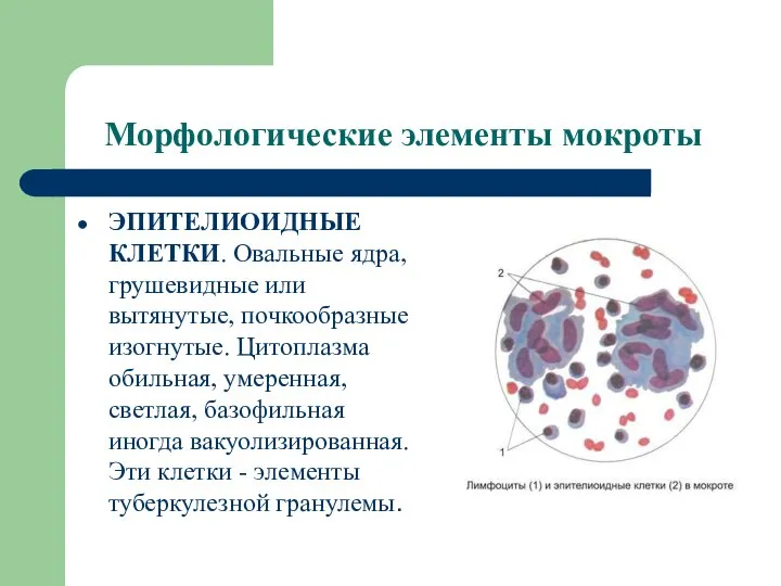 Морфологические элементы мокроты ЭПИТЕЛИОИДНЫЕ КЛЕТКИ. Овальные ядра, грушевидные или вытянутые, почкообразные изогнутые.