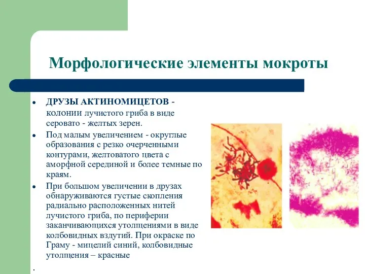 Морфологические элементы мокроты ДРУЗЫ АКТИНОМИЦЕТОВ - колонии лучистого гриба в виде серовато