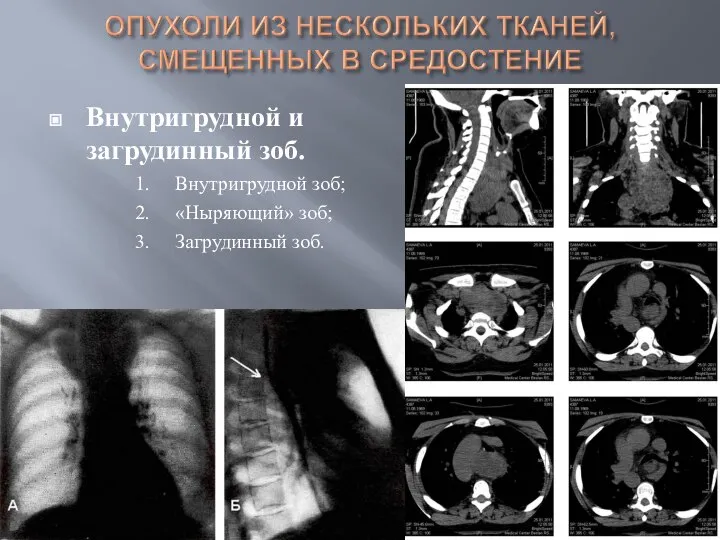 Внутригрудной и загрудинный зоб. 1. Внутригрудной зоб; 2. «Ныряющий» зоб; 3. Загрудинный зоб.