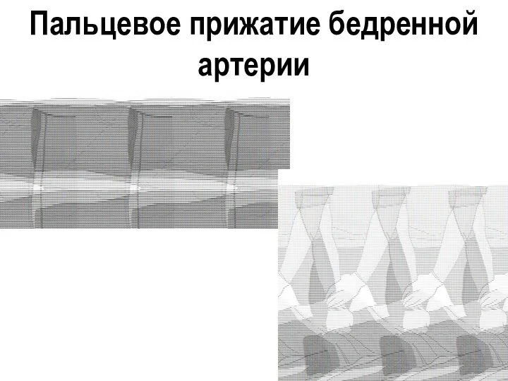 Пальцевое прижатие бедренной артерии