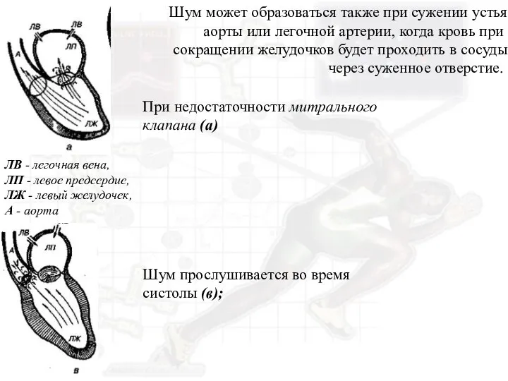 ЛВ - легочная вена, ЛП - левое предсердие, ЛЖ - левый желудочек,