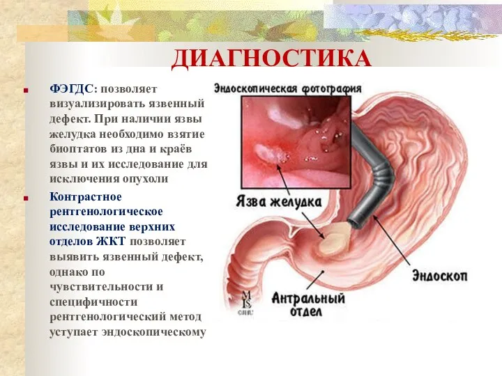 ДИАГНОСТИКА ФЭГДС: позволяет визуализировать язвенный дефект. При наличии язвы желудка необходимо взятие