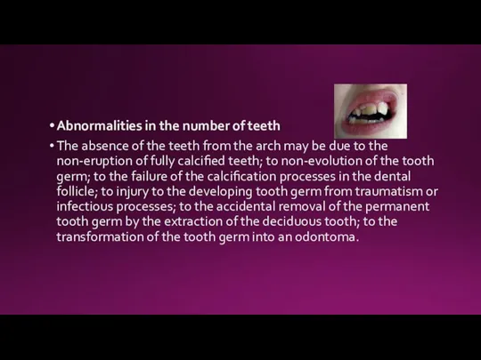 Abnormalities in the number of teeth The absence of the teeth from