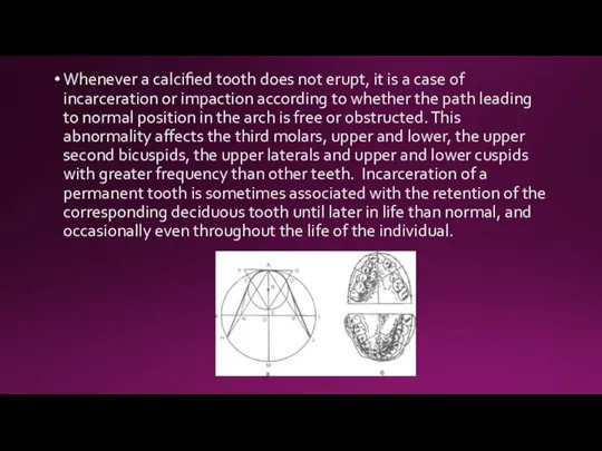 Whenever a calcified tooth does not erupt, it is a case of