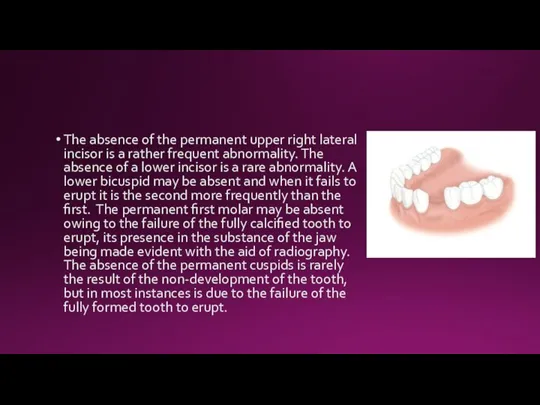 The absence of the permanent upper right lateral incisor is a rather