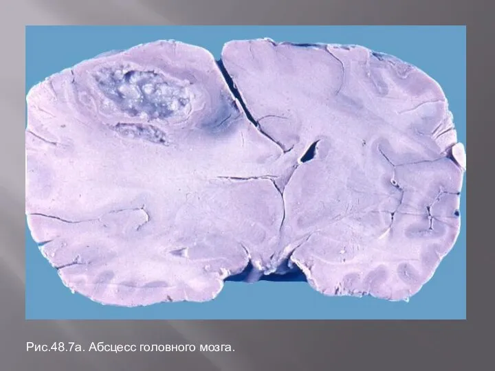 Рис.48.7а. Абсцесс головного мозга.