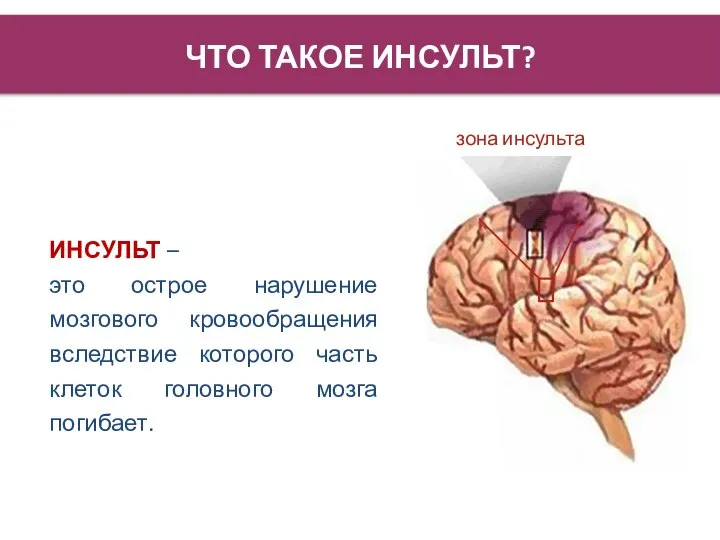 ЧТО ТАКОЕ ИНСУЛЬТ? ИНСУЛЬТ – это острое нарушение мозгового кровообращения, вследствие которого