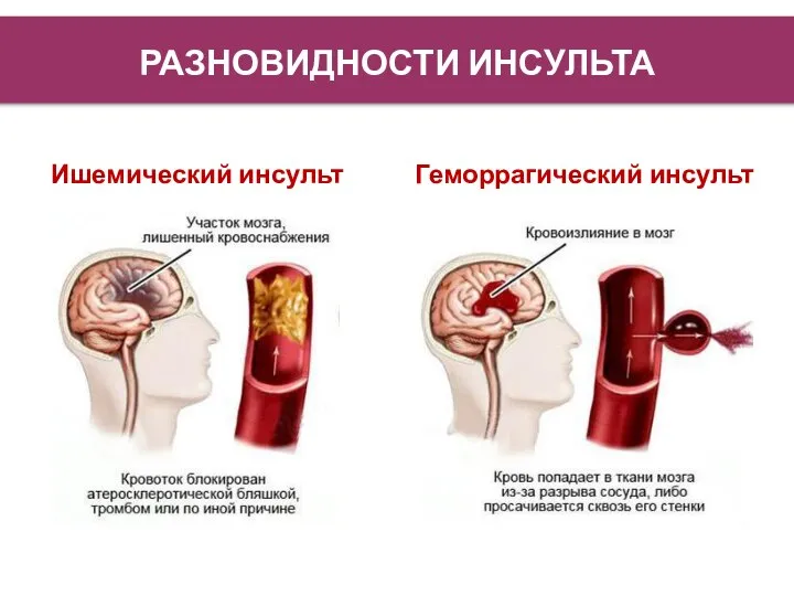 РАЗНОВИДНОСТИ ИНСУЛЬТА Ишемический инсульт Геморрагический инсульт