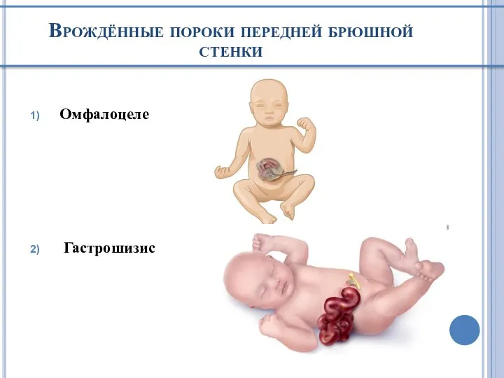 Врождённые пороки передней брюшной стенки Омфалоцеле Гастрошизис