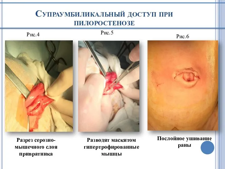 Супраумбиликальный доступ при пилоростенозе Разрез серозно-мышечного слоя привратника Разводят маскитом гипертрофированные мышцы