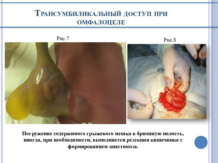 Трансумбиликальный доступ при омфалоцеле Рис.7 Рис.8 Погружение содержимого грыжевого мешка в брюшную