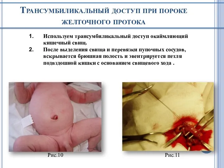 Трансумбиликальный доступ при пороке желточного протока Используем трансумбиликальный доступ окаймляющий кишечный свищ.