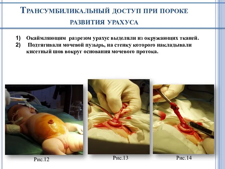 Трансумбиликальный доступ при пороке развития урахуса Окаймляющим разрезом урахус выделяли из окружающих