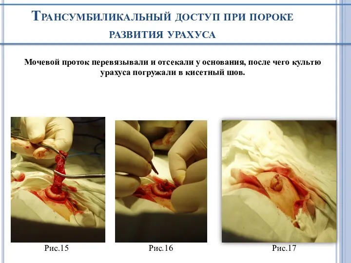 Трансумбиликальный доступ при пороке развития урахуса Мочевой проток перевязывали и отсекали у