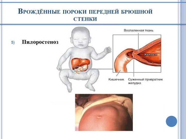 Врождённые пороки передней брюшной стенки Пилоростеноз