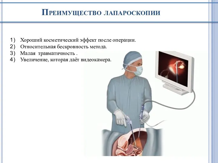 Преимущество лапароскопии Хороший косметический эффект после операции. Относительная бескровность метода. Малая травматичность