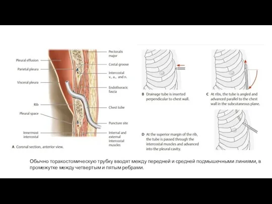 Обычно торакостомическую трубку вводят между передней и средней подмышечными линиями, в промежутке
