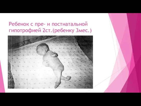 Ребенок с пре- и постнатальной гипотрофией 2ст.(ребенку 3мес.)