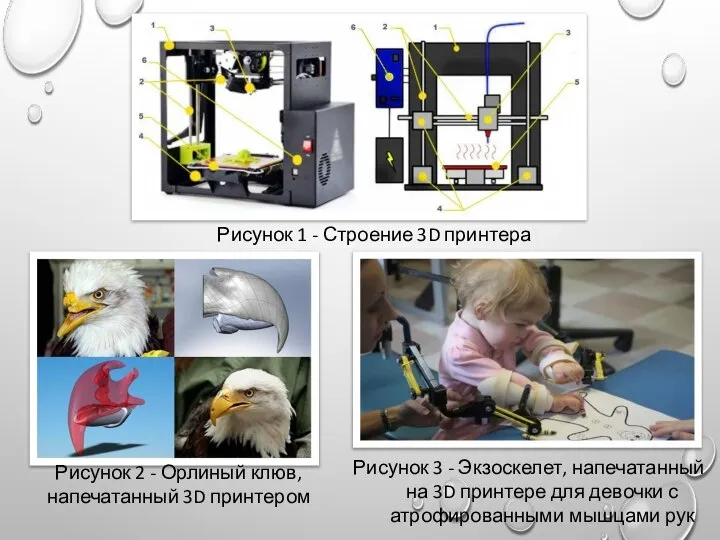 Рисунок 3 - Экзоскелет, напечатанный на 3D принтере для девочки с атрофированными