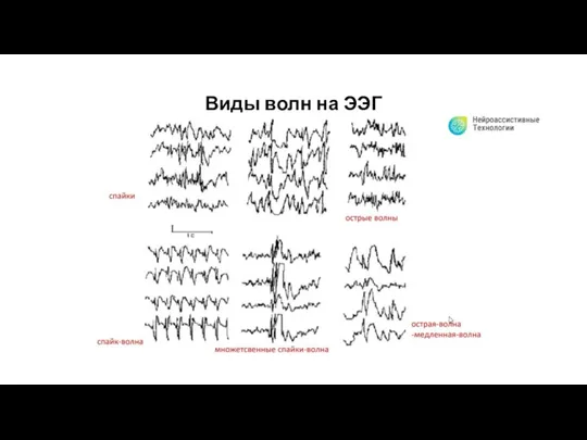 Виды волн на ЭЭГ