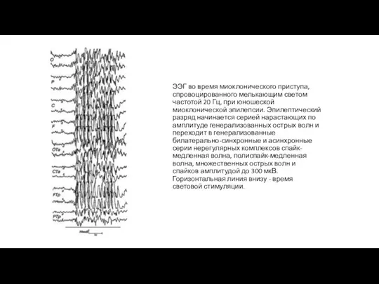 ЭЭГ во время миоклонического приступа, спровоцированного мелькающим светом частотой 20 Гц, при