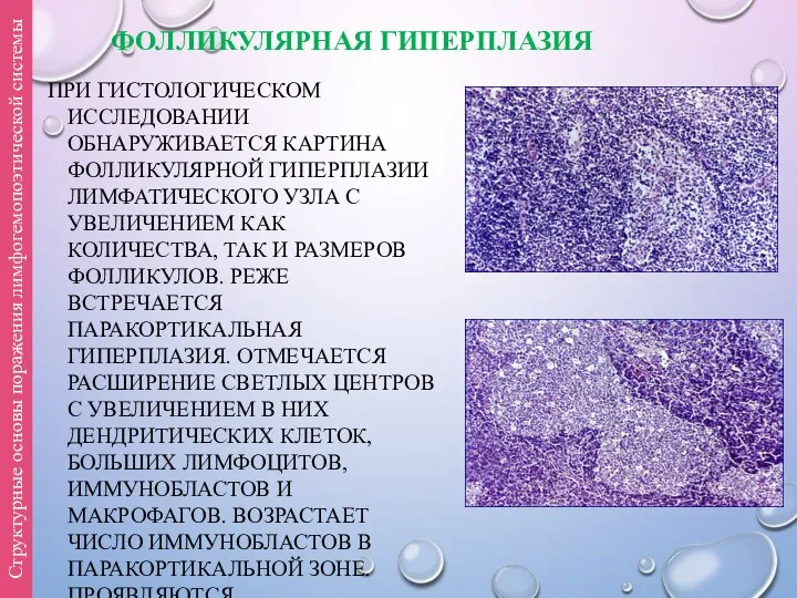 ФОЛЛИКУЛЯРНАЯ ГИПЕРПЛАЗИЯ ПРИ ГИСТОЛОГИЧЕСКОМ ИССЛЕДОВАНИИ ОБНАРУЖИВАЕТСЯ КАРТИНА ФОЛЛИКУЛЯРНОЙ ГИПЕРПЛАЗИИ ЛИМФАТИЧЕСКОГО УЗЛА С