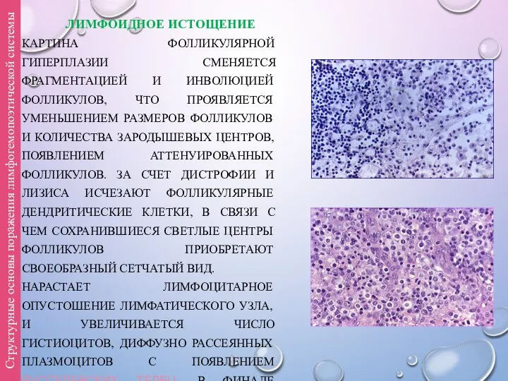 ЛИМФОИДНОЕ ИСТОЩЕНИЕ КАРТИНА ФОЛЛИКУЛЯРНОЙ ГИПЕРПЛАЗИИ СМЕНЯЕТСЯ ФРАГМЕНТАЦИЕЙ И ИНВОЛЮЦИЕЙ ФОЛЛИКУЛОВ, ЧТО ПРОЯВЛЯЕТСЯ