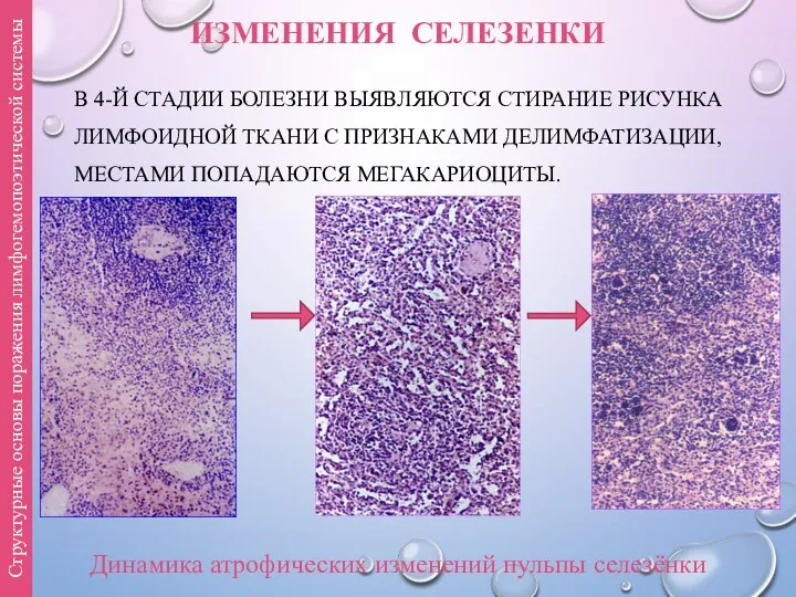 ИЗМЕНЕНИЯ СЕЛЕЗЕНКИ В 4-Й СТАДИИ БОЛЕЗНИ ВЫЯВЛЯЮТСЯ СТИРАНИЕ РИСУНКА ЛИМФОИДНОЙ ТКАНИ С