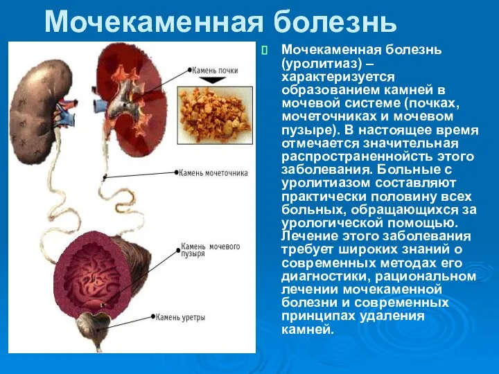 Мочекаменная болезнь Мочекаменная болезнь (уролитиаз) – характеризуется образованием камней в мочевой системе