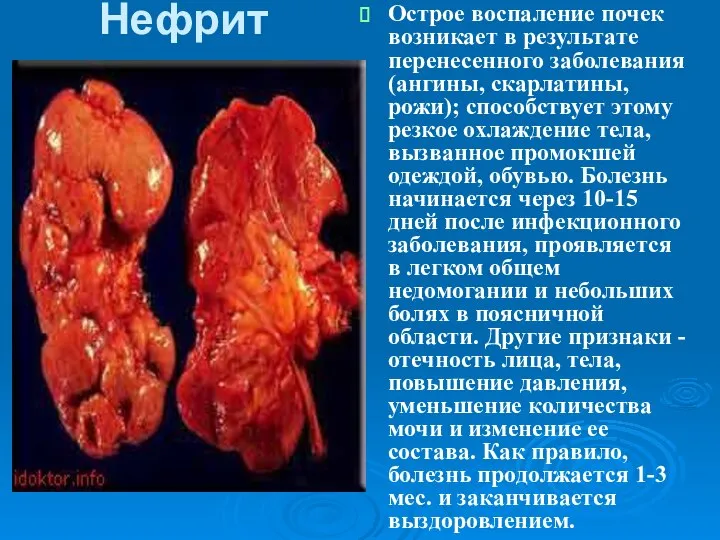 Нефрит Острое воспаление почек возникает в результате перенесенного заболевания (ангины, скарлатины, рожи);