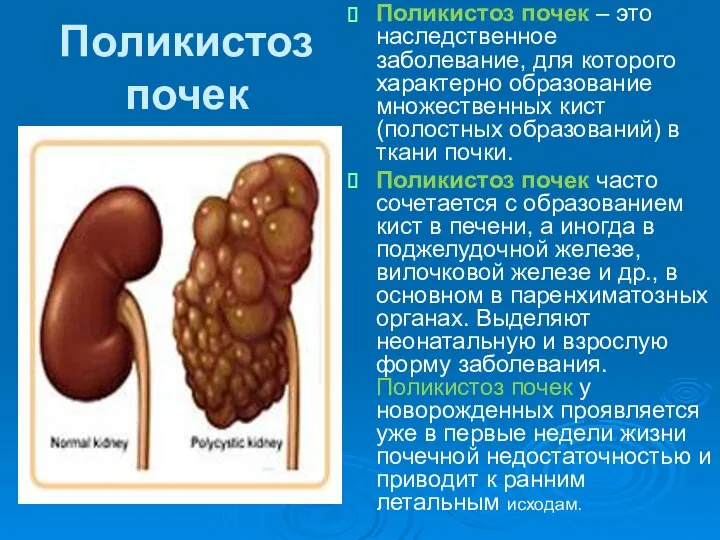 Поликистоз почек Поликистоз почек – это наследственное заболевание, для которого характерно образование