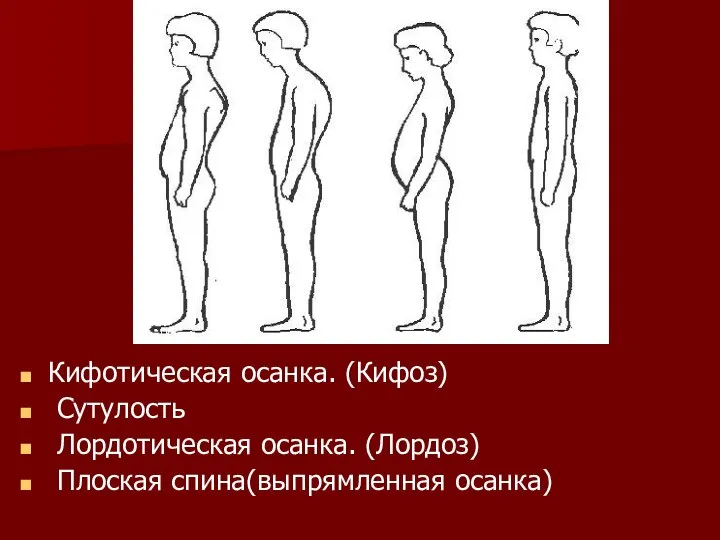 Кифотическая осанка. (Кифоз) Сутулость Лордотическая осанка. (Лордоз) Плоская спина(выпрямленная осанка)