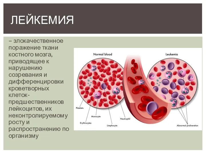 – злокачественное поражение ткани костного мозга, приводящее к нарушению созревания и дифференцировки