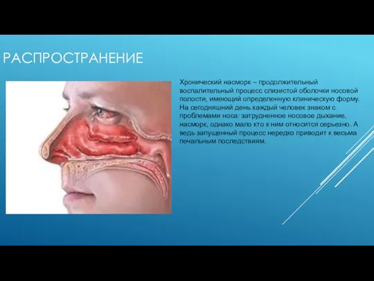 РАСПРОСТРАНЕНИЕ Хронический насморк – продолжительный воспалительный процесс слизистой оболочки носовой полости, имеющий