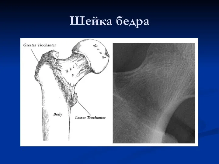 Шейка бедра